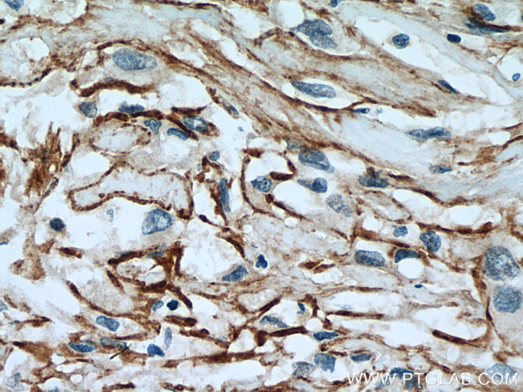 Immunohistochemical analysis of paraffin-embedded human renal cell carcinoma tissue slide using 26864-1-AP (SLC7A11/xCT antibody) at dilution of 1:200 (under 40x lens). Heat mediated antigen retrieval with Tris-EDTA buffer (pH 9.0).