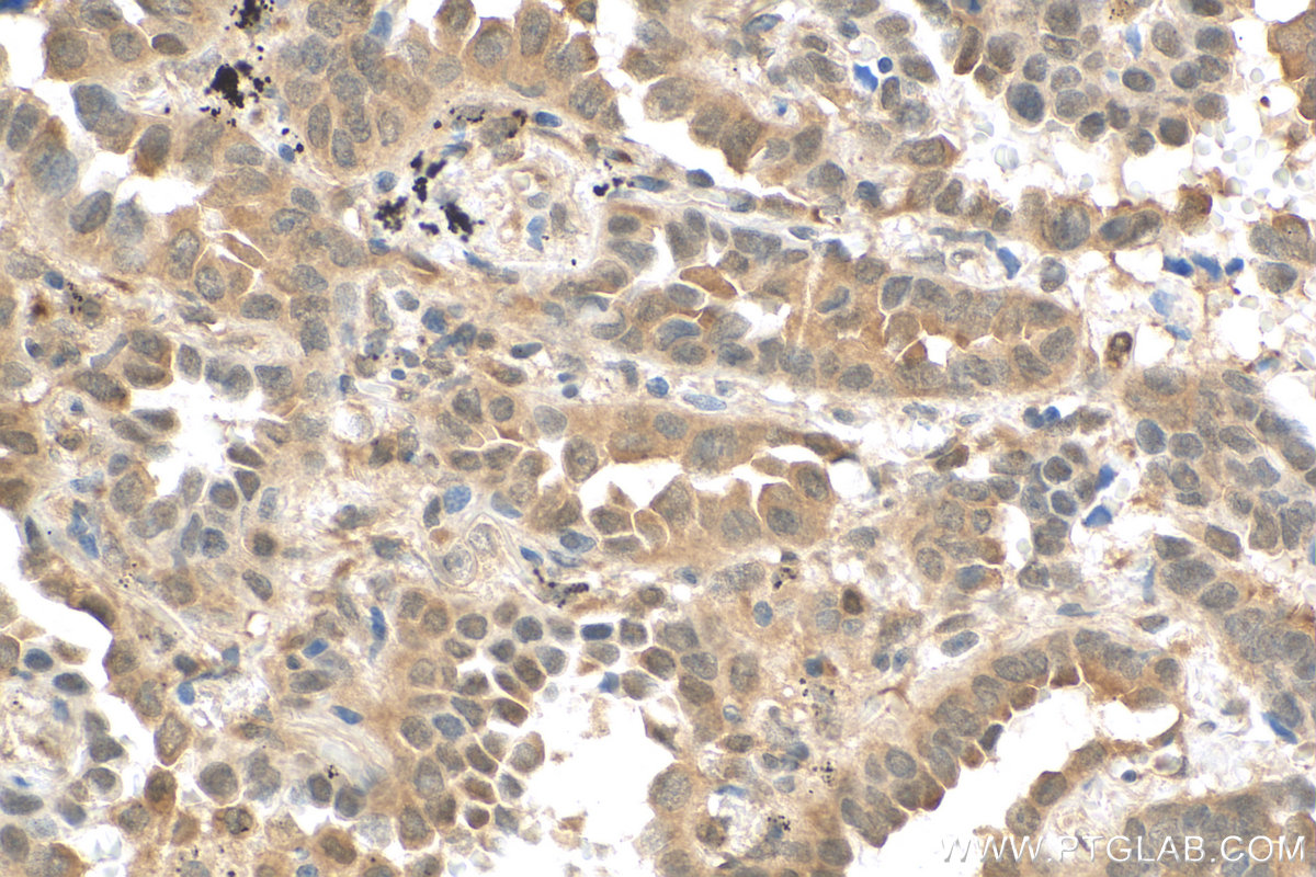 Immunohistochemical analysis of paraffin-embedded human lung cancer tissue slide using 80744-1-RR (KEAP1 antibody) at dilution of 1:1000 (under 40x lens). Heat mediated antigen retrieval with Tris-EDTA buffer (pH 9.0).