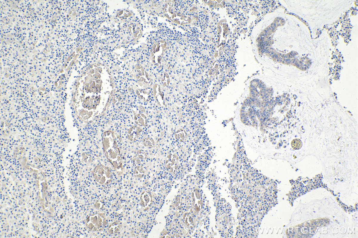 Immunohistochemical analysis of paraffin-embedded human colon cancer tissue slide using 81004-1-RR (LC3 antibody) at dilution of 1:500 (under 10x lens). Heat mediated antigen retrieval with Tris-EDTA buffer (pH 9.0).
