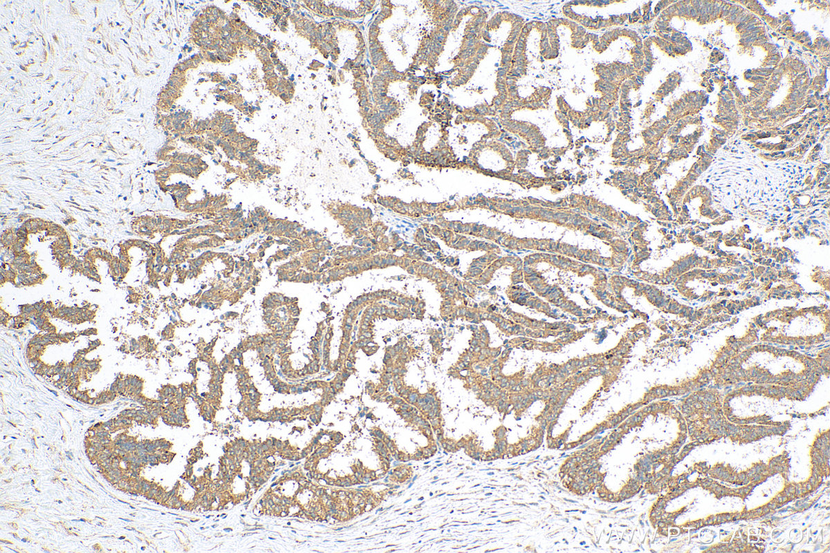 Immunohistochemical analysis of paraffin-embedded human ovary tumor tissue slide using 81803-1-RR (ATG5 antibody) at dilution of 1:1000 (under 10x lens). Heat mediated antigen retrieval with Tris-EDTA buffer (pH 9.0).