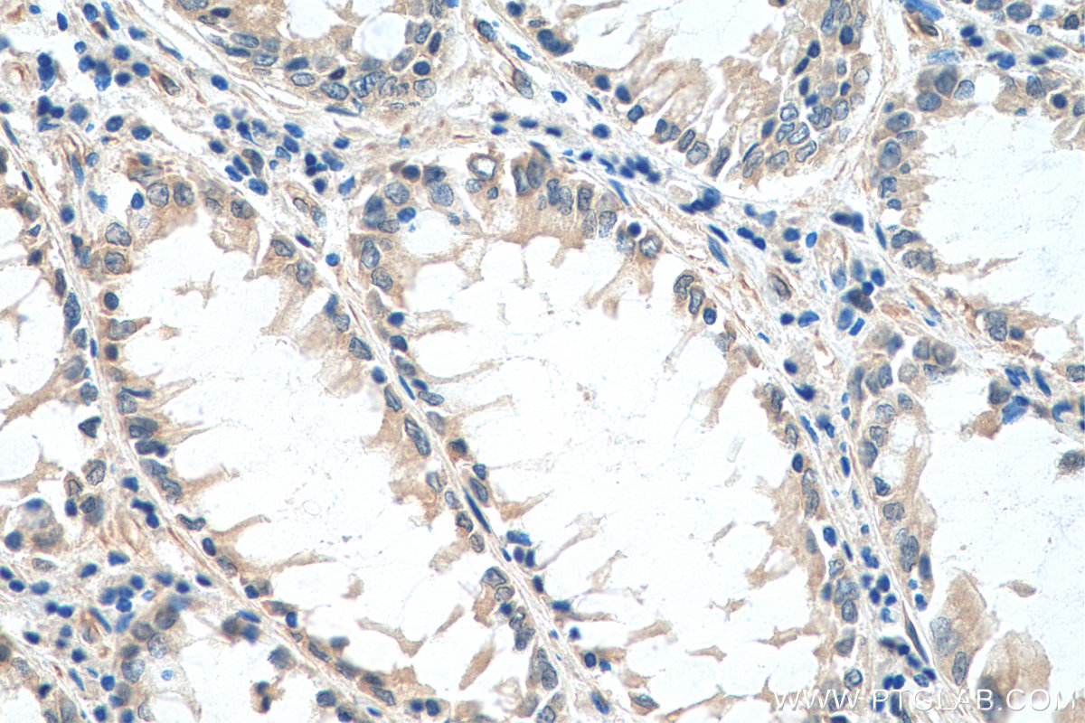 Immunohistochemical analysis of paraffin-embedded human colon cancer tissue slide using 29445-1-AP (ATG16L1 antibody) at dilution of 1:400 (under 40x lens). Heat mediated antigen retrieval with Tris-EDTA buffer (pH 9.0).
