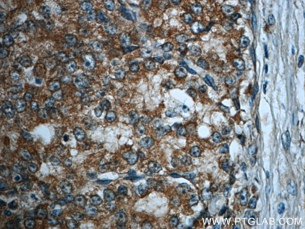 Immunohistochemical analysis of paraffin-embedded human prostate cancer slide using 11122-1-AP (ATG12 Antibody) at dilution of 1:50.