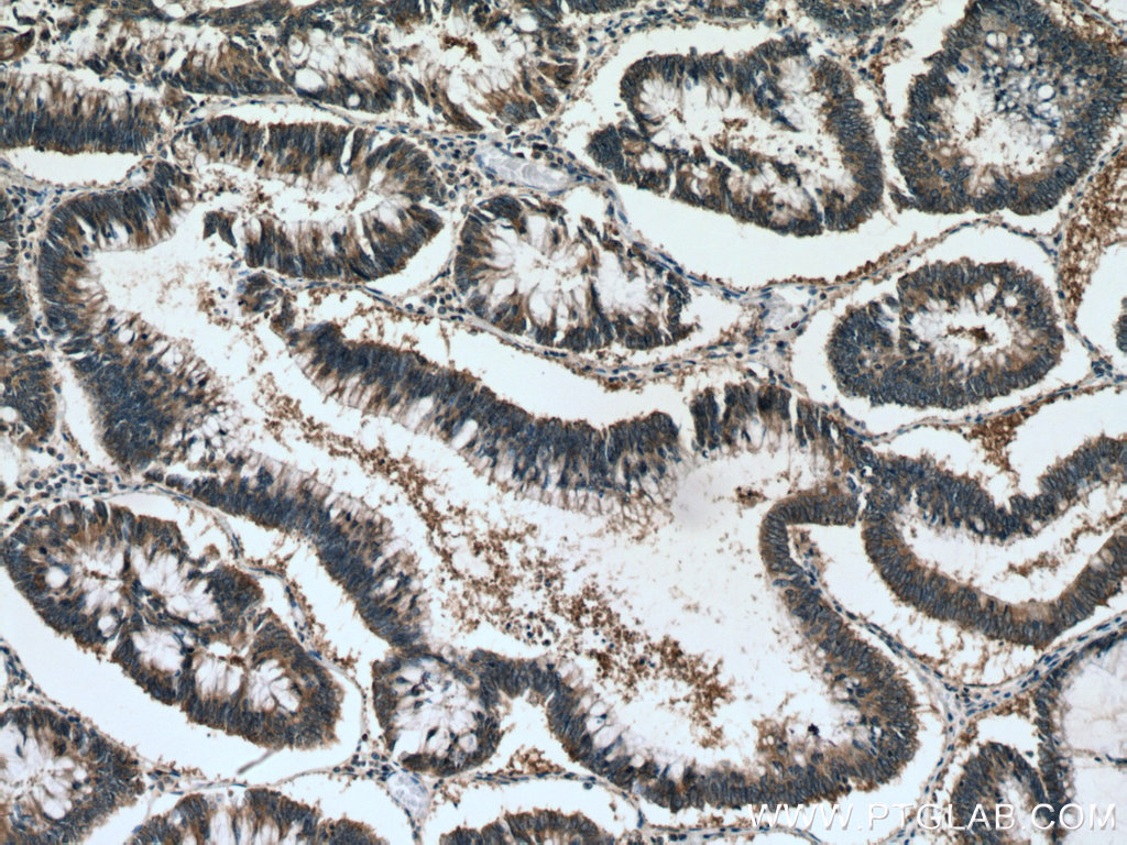 Immunohistochemical analysis of paraffin-embedded human colon cancer tissue slide using 11264-1-AP (ATG12 antibody) at dilution of 1:200 (under 10x lens). Heat mediated antigen retrieval with Tris-EDTA buffer (pH 9.0).