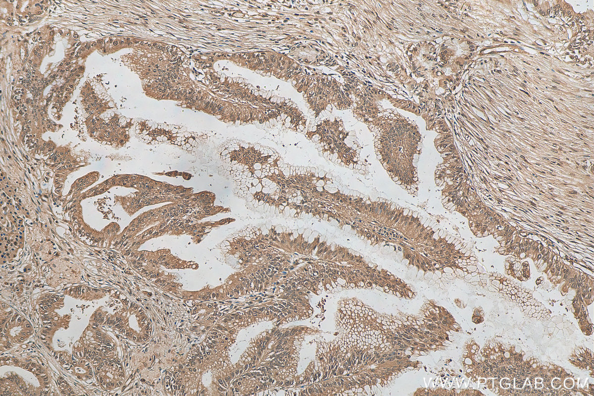 Immunohistochemical analysis of paraffin-embedded human pancreas cancer tissue slide using 80992-1-RR (ubiquitin antibody) at dilution of 1:200 (under 10x lens). Heat mediated antigen retrieval with Tris-EDTA buffer (pH 9.0).