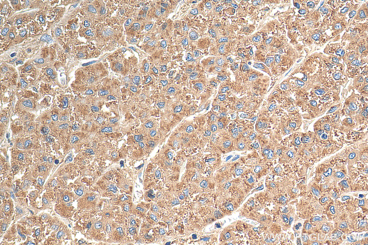 Immunohistochemical analysis of paraffin-embedded human liver cancer tissue slide using 21997-1-AP (LAMP1 antibody) at dilution of 1:200 (under 40x lens). Heat mediated antigen retrieval with Tris-EDTA buffer (pH 9.0).