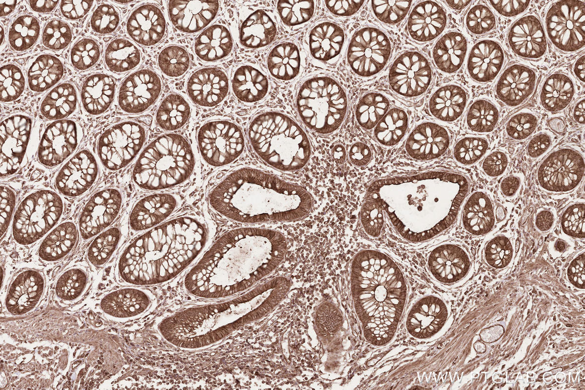 Immunohistochemical analysis of paraffin-embedded human rectal cancer tissue slide using KHC2588 (AAGAB IHC Kit).