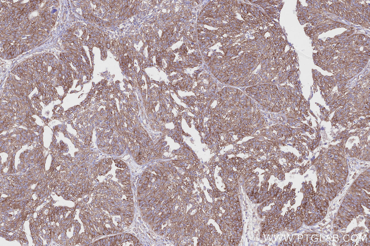 Immunohistochemical analysis of paraffin-embedded human ovary cancer tissue slide using KHC2664 (ABI1 IHC Kit).