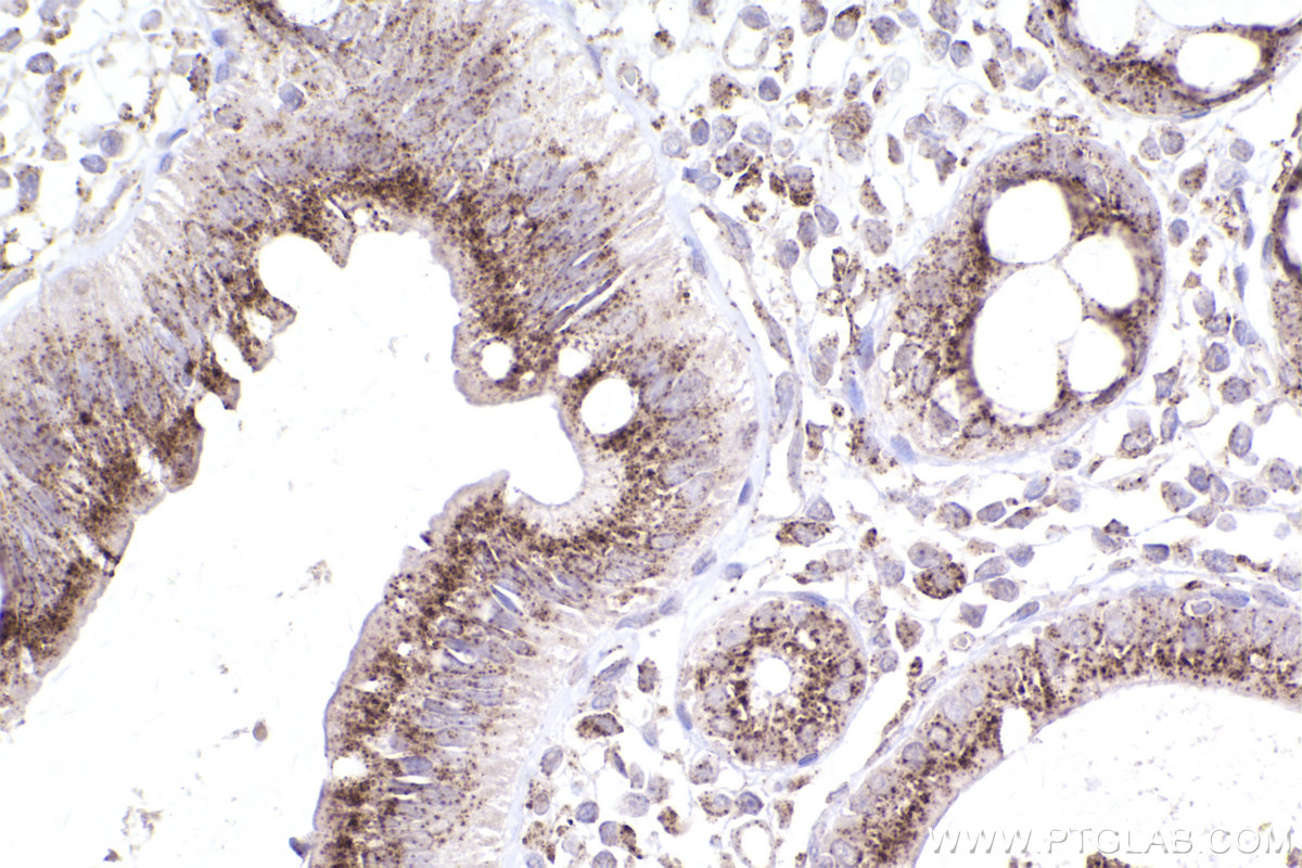 Immunohistochemical analysis of paraffin-embedded human rectal cancer tissue slide using KHC2556 (ACBD5 IHC Kit).