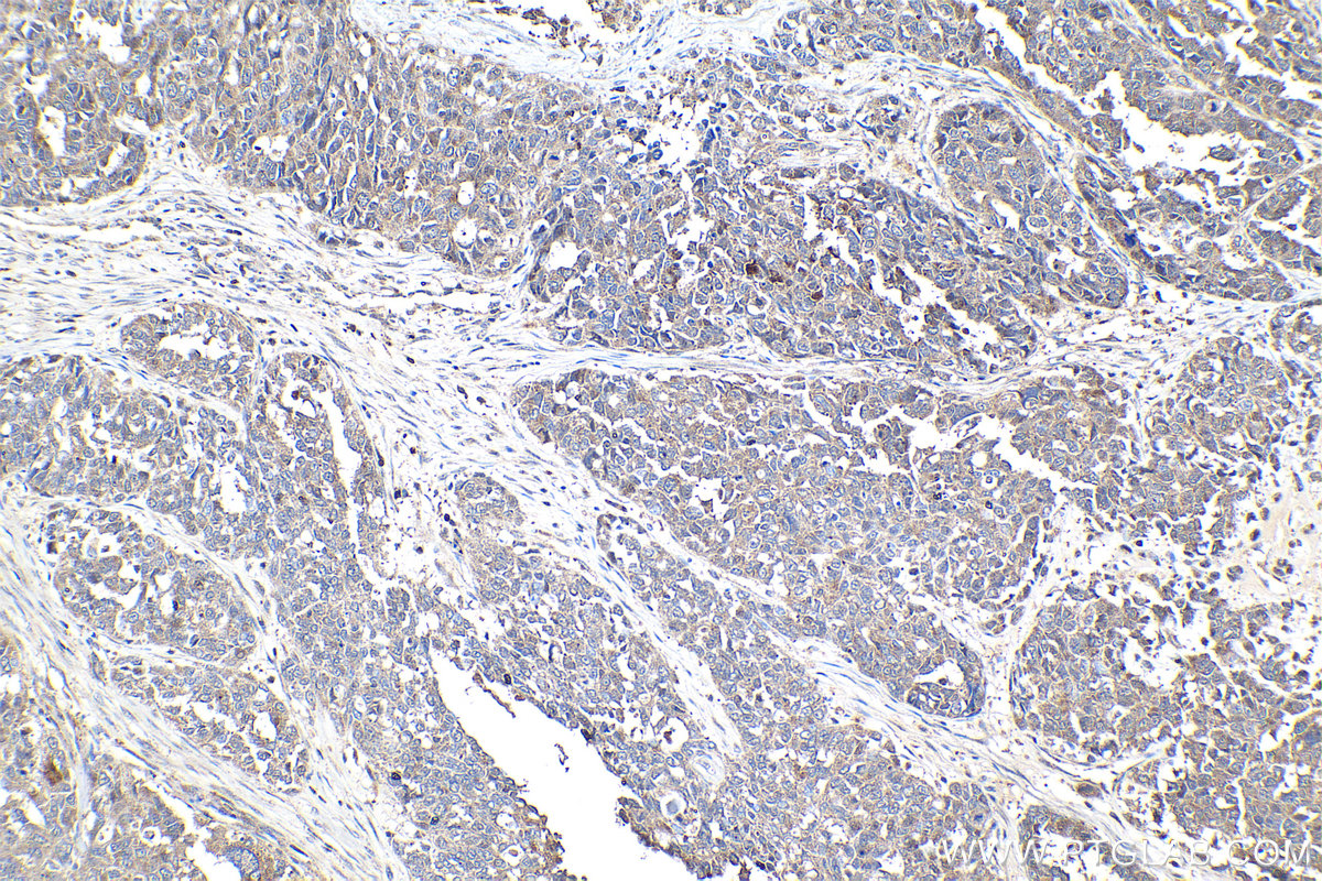 Immunohistochemical analysis of paraffin-embedded human ovary cancer tissue slide using KHC2089 (AKAP10 IHC Kit).