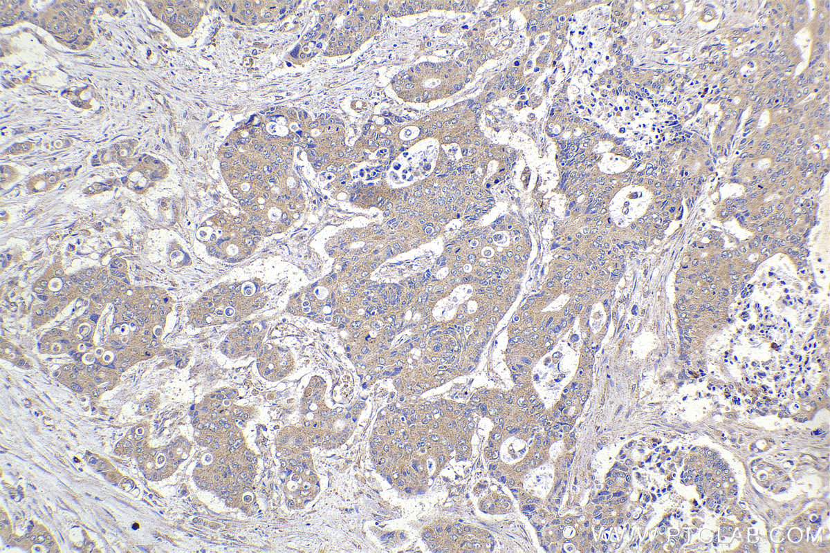 Immunohistochemical analysis of paraffin-embedded human stomach cancer tissue slide using KHC2191 (ANK1 IHC Kit).