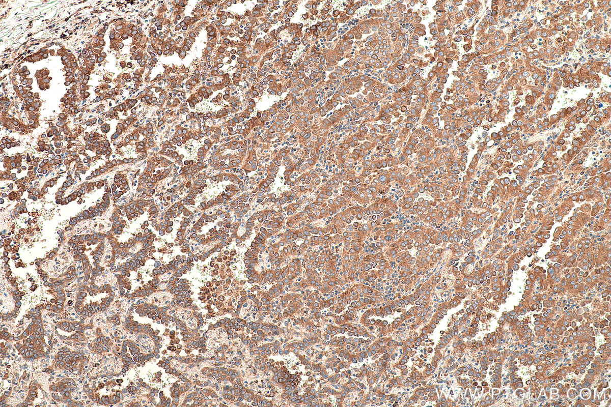 Immunohistochemical analysis of paraffin-embedded human lung cancer tissue slide using KHC0808 (Amphiregulin IHC Kit).