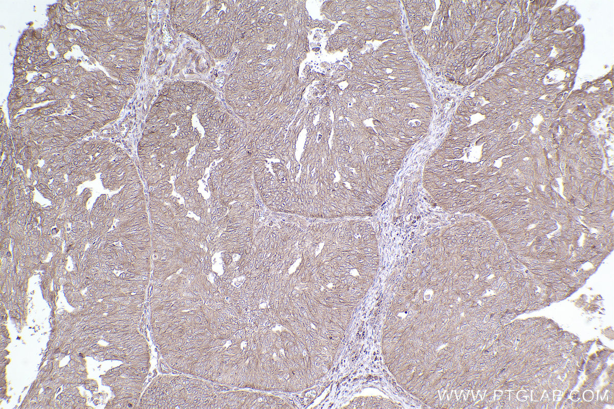 Immunohistochemical analysis of paraffin-embedded human ovary cancer tissue slide using KHC2555 (ARHGAP21 IHC Kit).