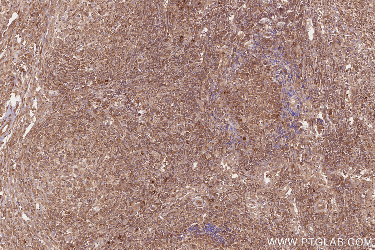 Immunohistochemical analysis of paraffin-embedded human lymphoma tissue slide using KHC2607 (ARHGAP27 IHC Kit).