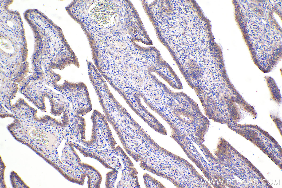 Immunohistochemical analysis of paraffin-embedded human ovary tumor tissue slide using KHC2414 (ARHGAP5 IHC Kit).