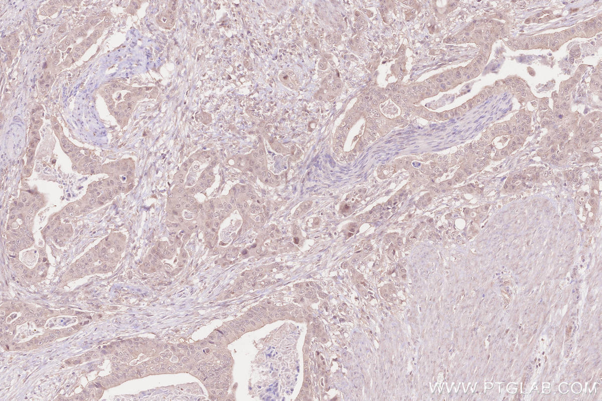 Immunohistochemical analysis of paraffin-embedded human stomach cancer tissue slide using KHC2605 (ARHGEF18 IHC Kit).