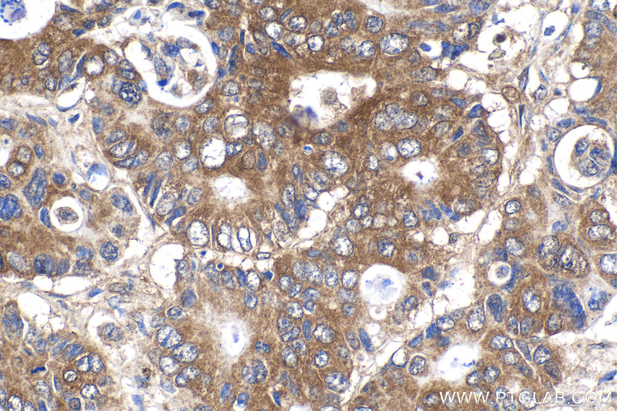 Immunohistochemical analysis of paraffin-embedded human stomach cancer tissue slide using KHC2145 (ASMTL IHC Kit).
