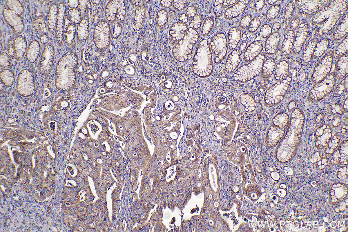 Immunohistochemical analysis of paraffin-embedded human stomach cancer tissue slide using KHC2379 (ATP2C1 IHC Kit).