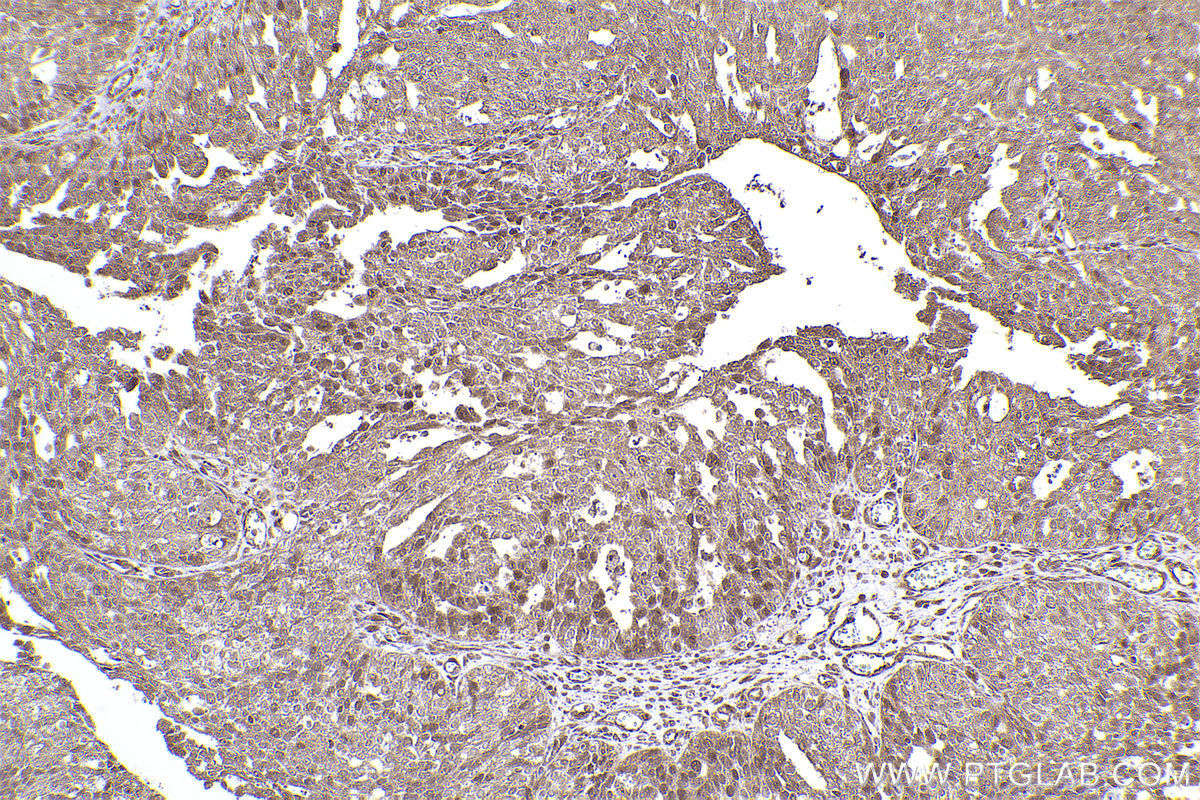 Immunohistochemical analysis of paraffin-embedded human ovary cancer tissue slide using KHC2431 (ATR IHC Kit).