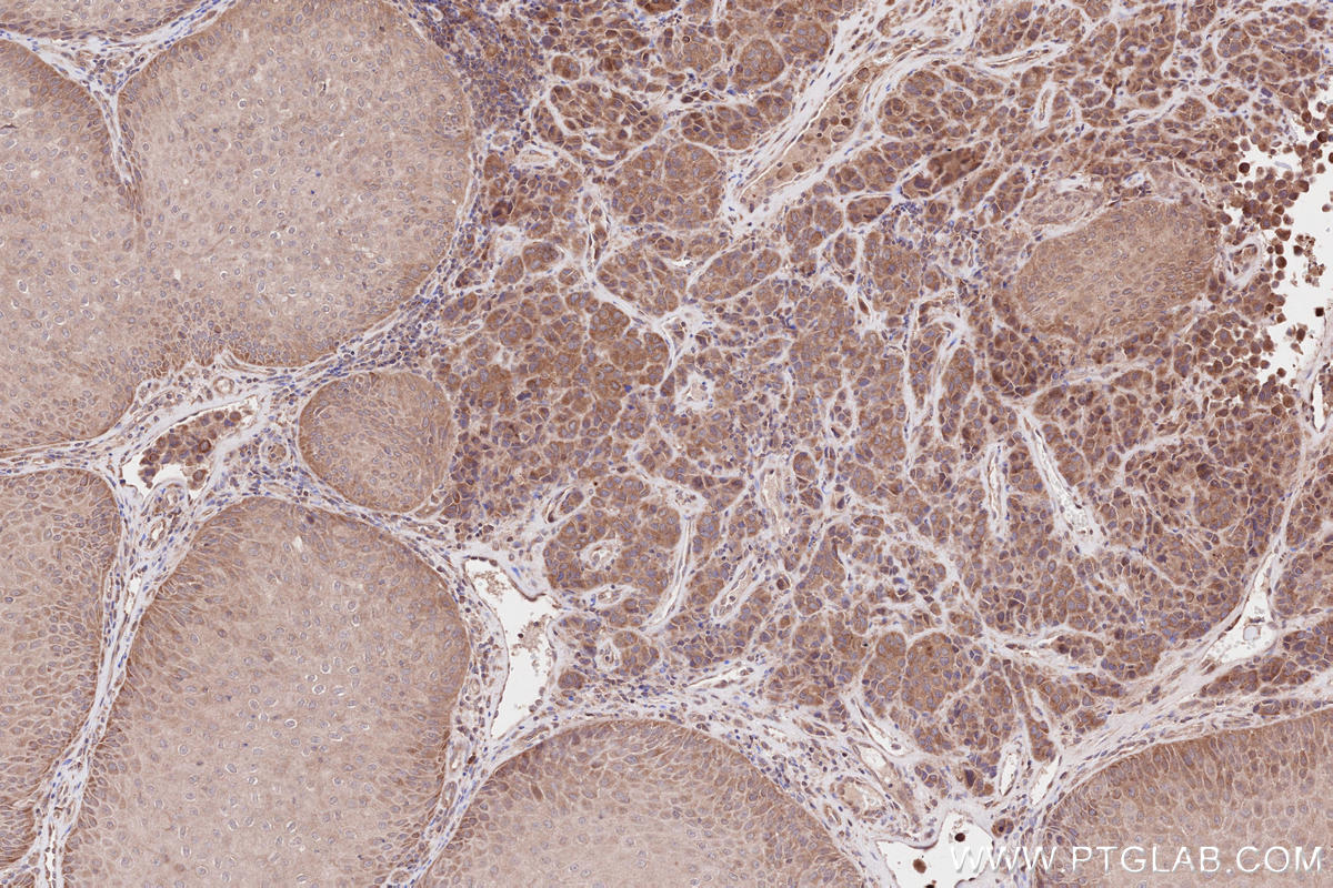 Immunohistochemical analysis of paraffin-embedded human malignant melanoma tissue slide using KHC2596 (ATRAID/C2orf28 IHC Kit).