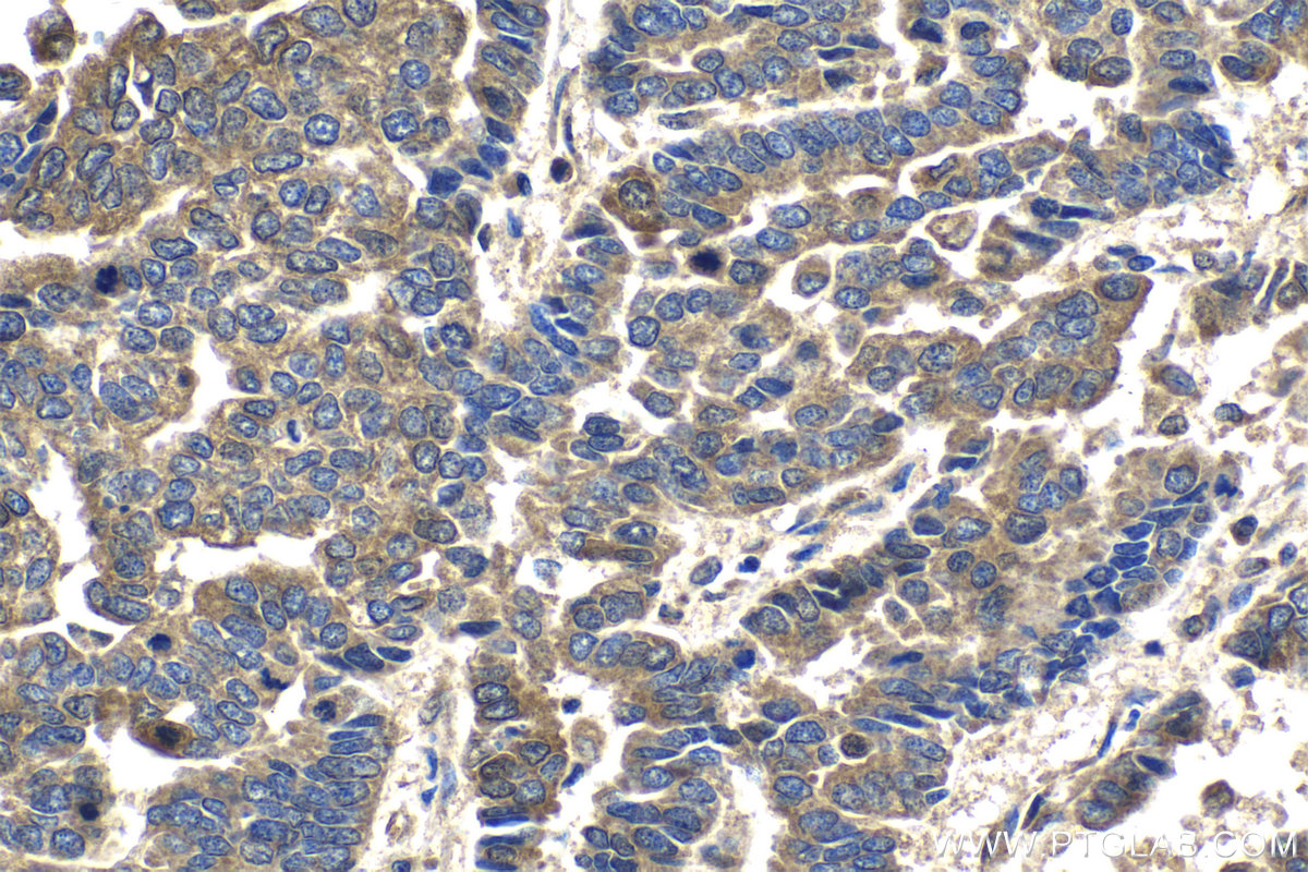 Immunohistochemical analysis of paraffin-embedded human ovary tumor tissue slide using KHC2148 (BAG2 IHC Kit).