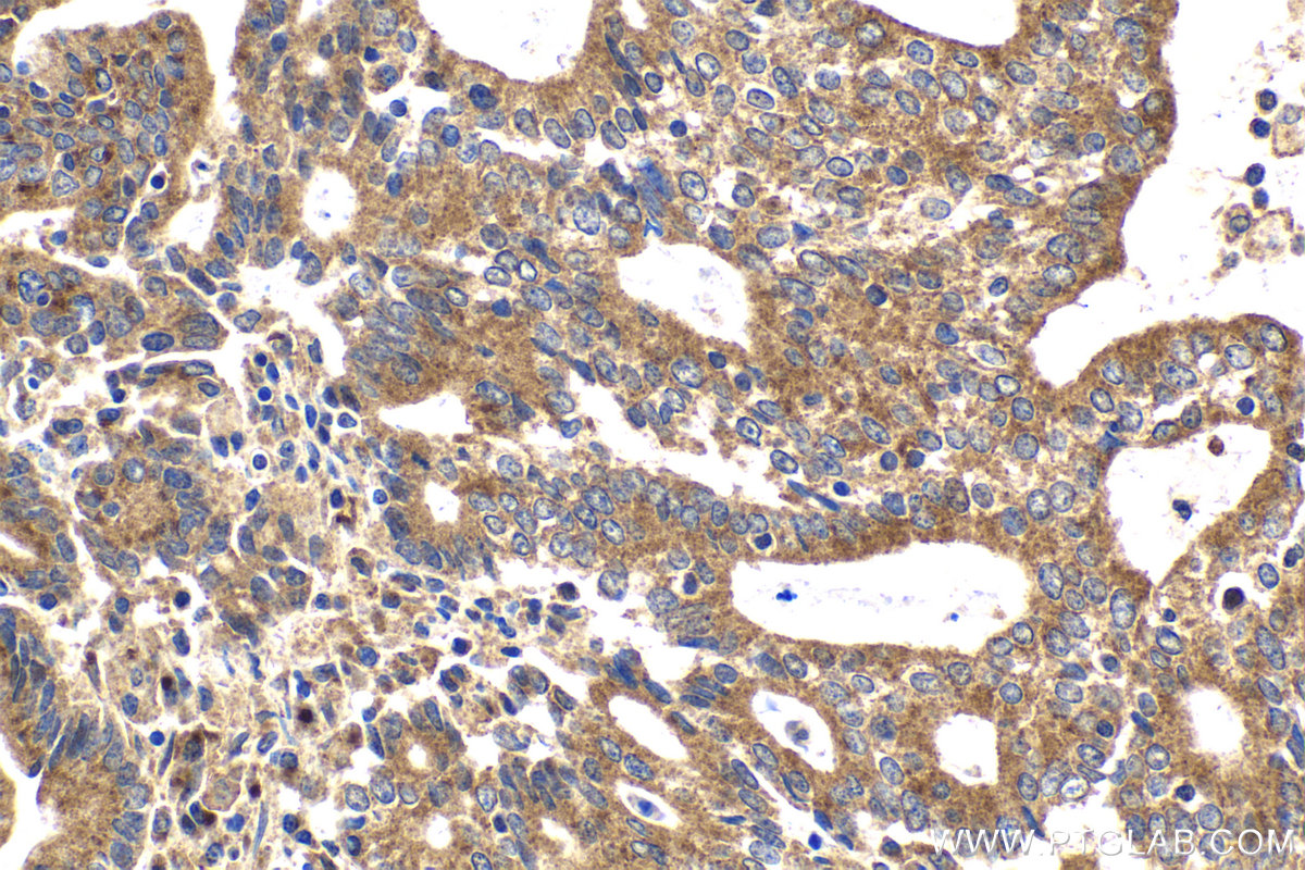 Immunohistochemical analysis of paraffin-embedded human endometrial cancer tissue slide using KHC2150 (BMP15 IHC Kit).