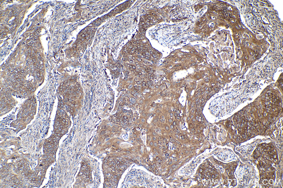 Immunohistochemical analysis of paraffin-embedded human cervical cancer tissue slide using KHC2099 (BUB1B IHC Kit).