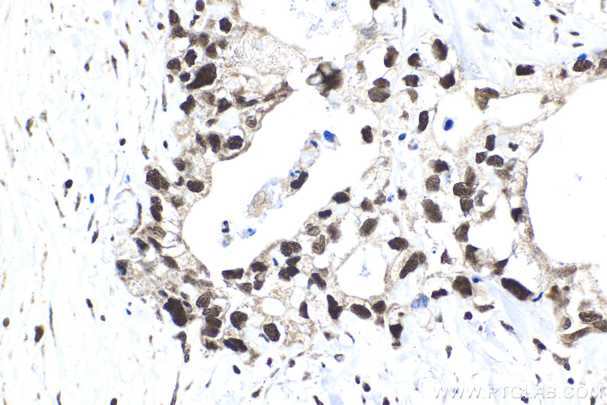 Immunohistochemical analysis of paraffin-embedded human pancreas cancer tissue slide using KHC2091 (BUB3 IHC Kit).