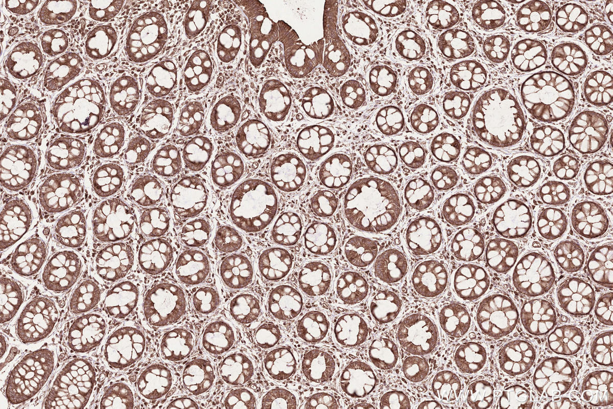 Immunohistochemical analysis of paraffin-embedded human rectal cancer tissue slide using KHC2526 (C20orf19 IHC Kit).