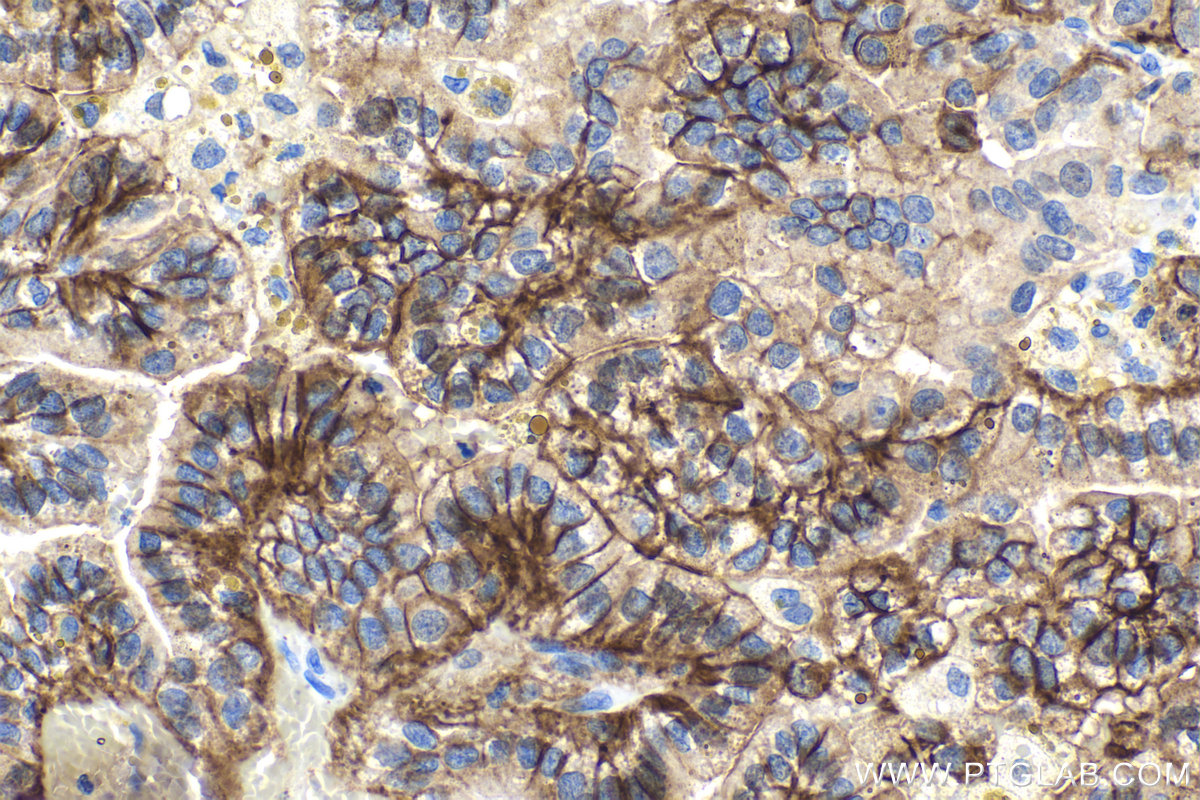 Immunohistochemical analysis of paraffin-embedded human renal cell carcinoma tissue slide using KHC2088 (CA12 IHC Kit).