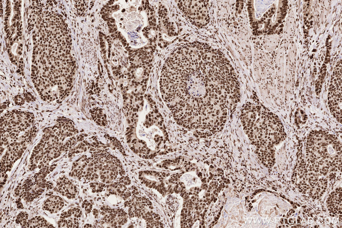 Immunohistochemical analysis of paraffin-embedded human stomach cancer tissue slide using KHC2580 (CAPRIN2 IHC Kit).