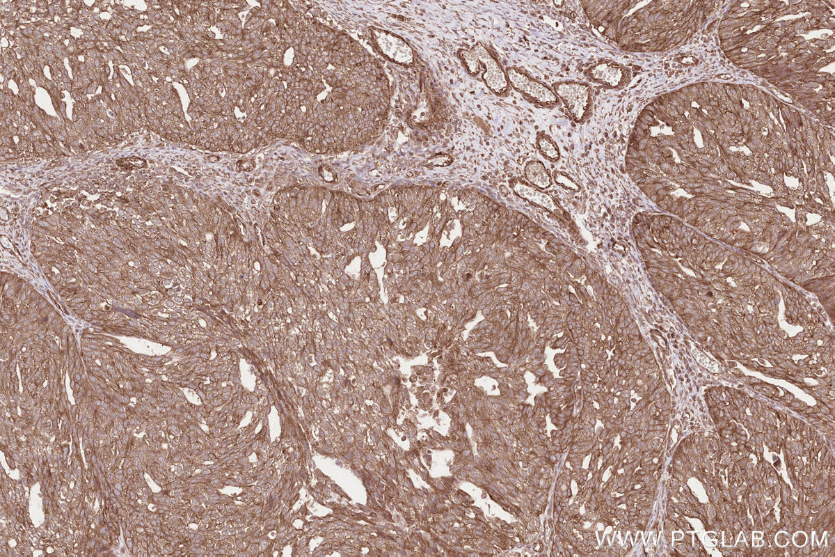 Immunohistochemical analysis of paraffin-embedded human ovary cancer tissue slide using KHC2538 (CCDC93 IHC Kit).