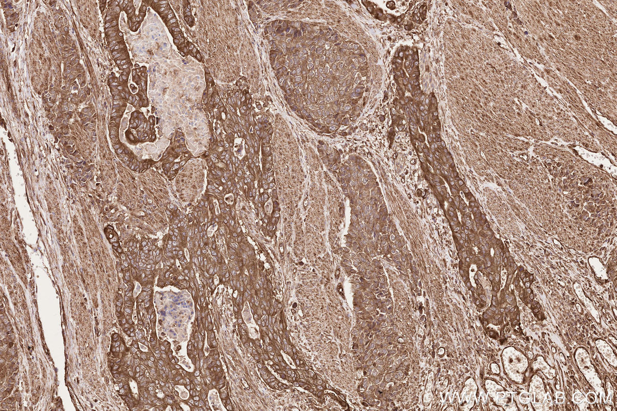 Immunohistochemical analysis of paraffin-embedded human stomach cancer tissue slide using KHC2538 (CCDC93 IHC Kit).