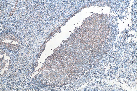 IHC staining of human tonsilitis with proteintech's CD11b IHCeasy kit KHC0027