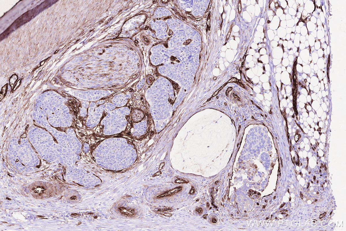 Immunohistochemical analysis of paraffin-embedded human stomach cancer tissue slide using KHC2511 (CD141/Thrombomodulin IHC Kit).