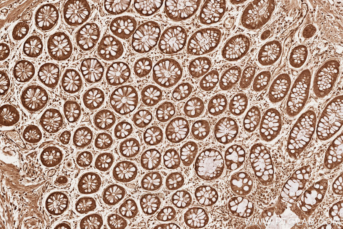 Immunohistochemical analysis of paraffin-embedded human rectal cancer tissue slide using KHC2520 (CDC37 IHC Kit).