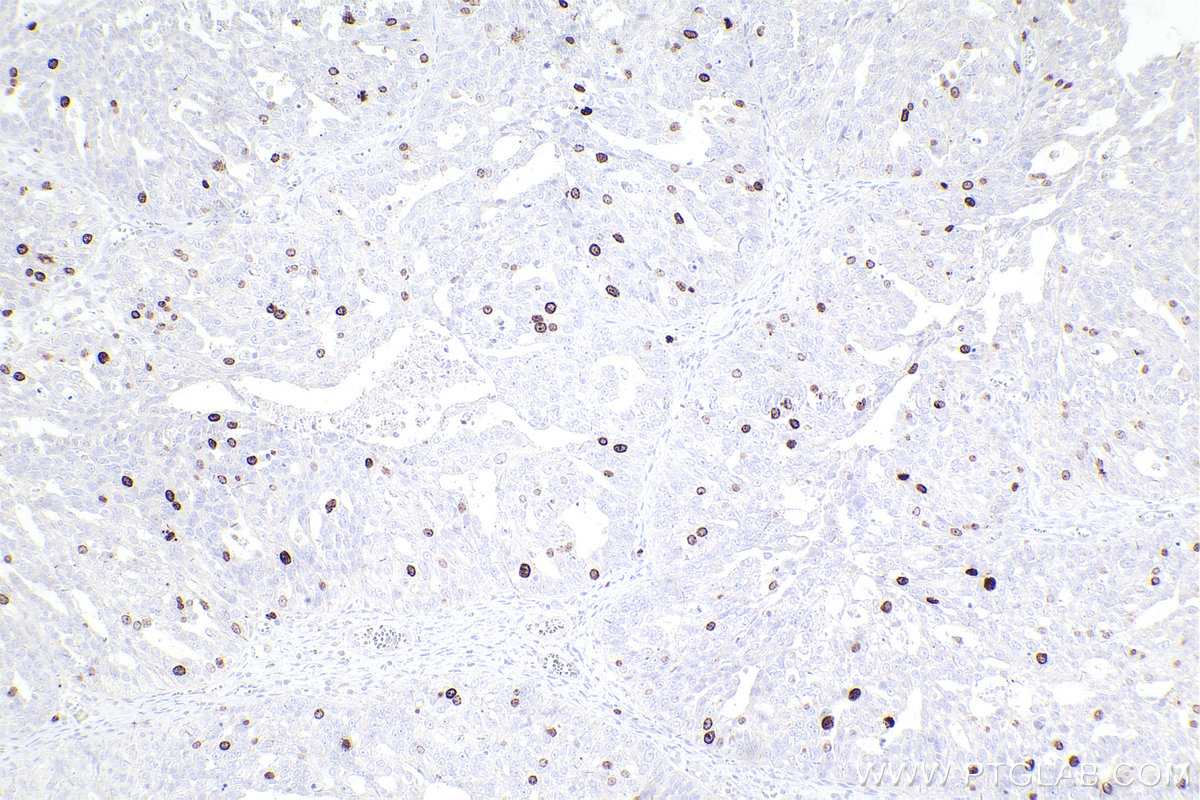 Immunohistochemical analysis of paraffin-embedded human ovary cancer tissue slide using KHC2536 (CDCA8 IHC Kit).