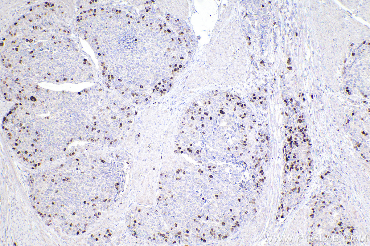 Immunohistochemical analysis of paraffin-embedded human stomach cancer tissue slide using KHC2536 (CDCA8 IHC Kit).