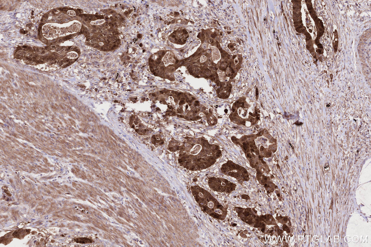 Immunohistochemical analysis of paraffin-embedded human stomach cancer tissue slide using KHC2681 (CDKN2A/P16INK4A IHC Kit).