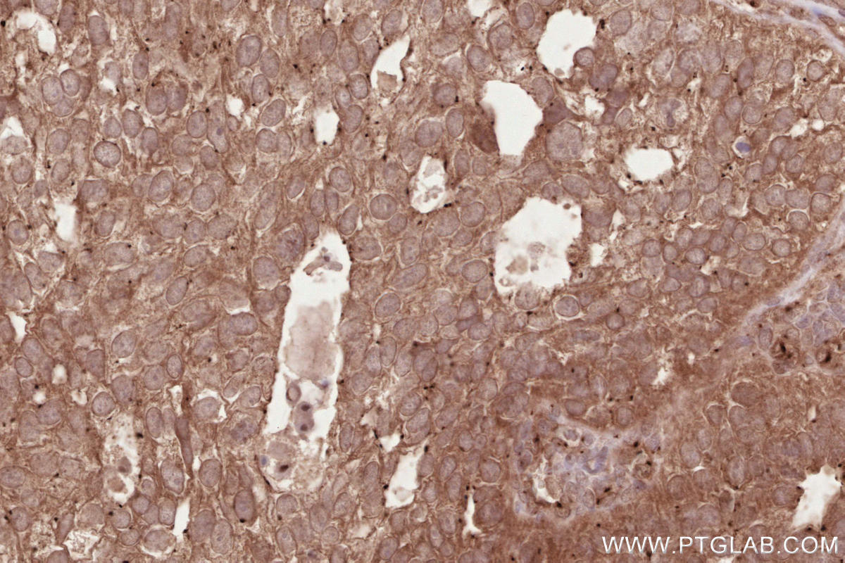 Immunohistochemical analysis of paraffin-embedded human ovary cancer tissue slide using KHC2611 (CEP68 IHC Kit).