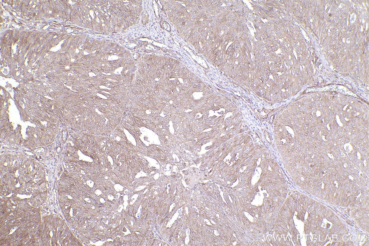 Immunohistochemical analysis of paraffin-embedded human ovary cancer tissue slide using KHC2547 (CEP78 IHC Kit).