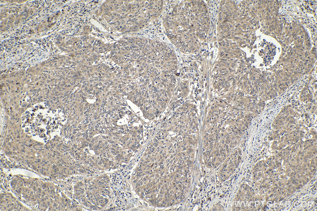 Immunohistochemical analysis of paraffin-embedded human cervical cancer tissue slide using KHC2018 (CNOT6 IHC Kit).