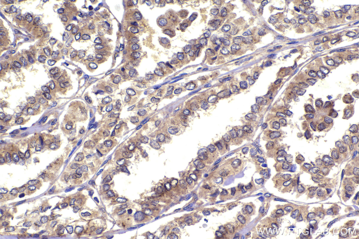 Immunohistochemical analysis of paraffin-embedded human thyroid cancer tissue slide using KHC2315 (COPB1 IHC Kit).