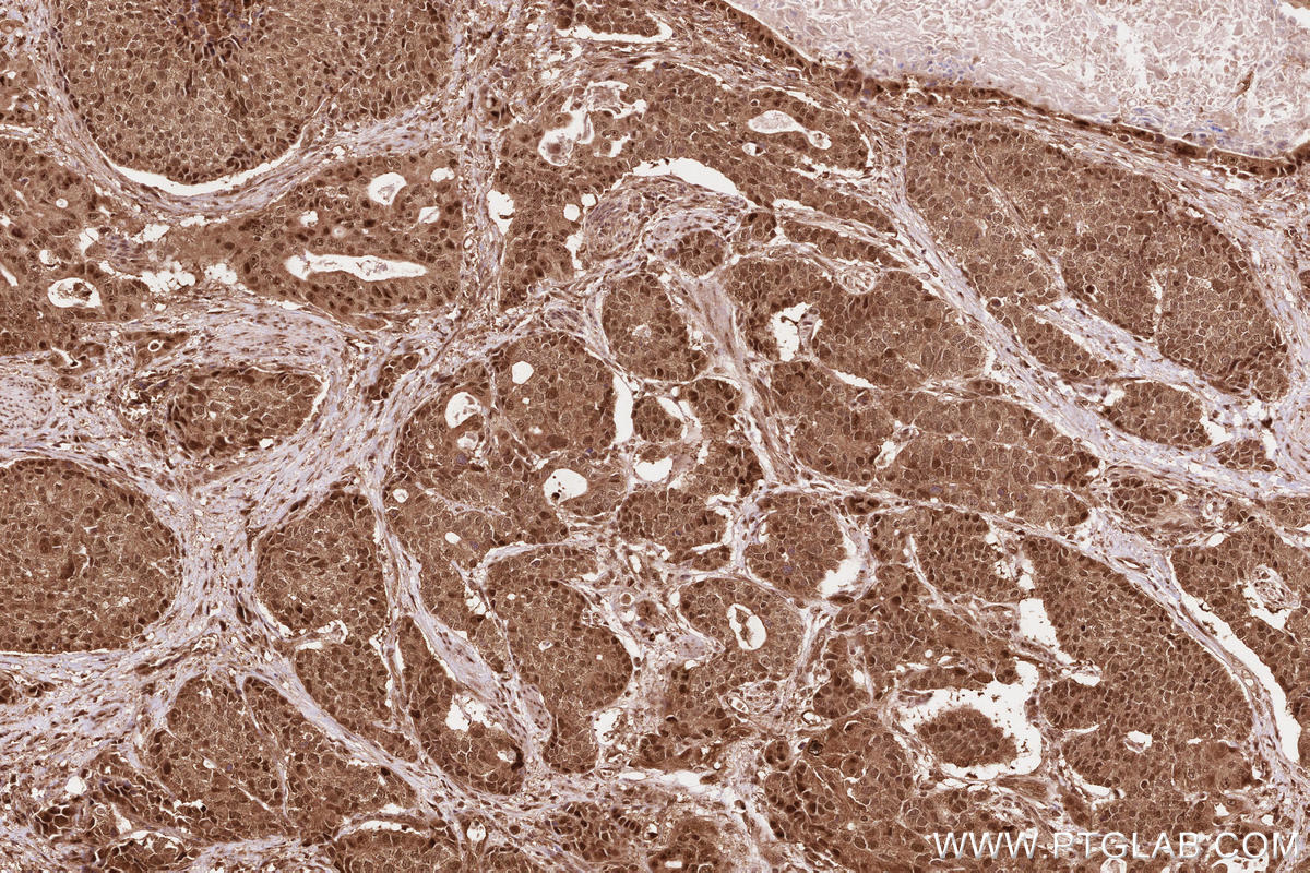 Immunohistochemical analysis of paraffin-embedded human stomach cancer tissue slide using KHC2614 (COPS6 IHC Kit).