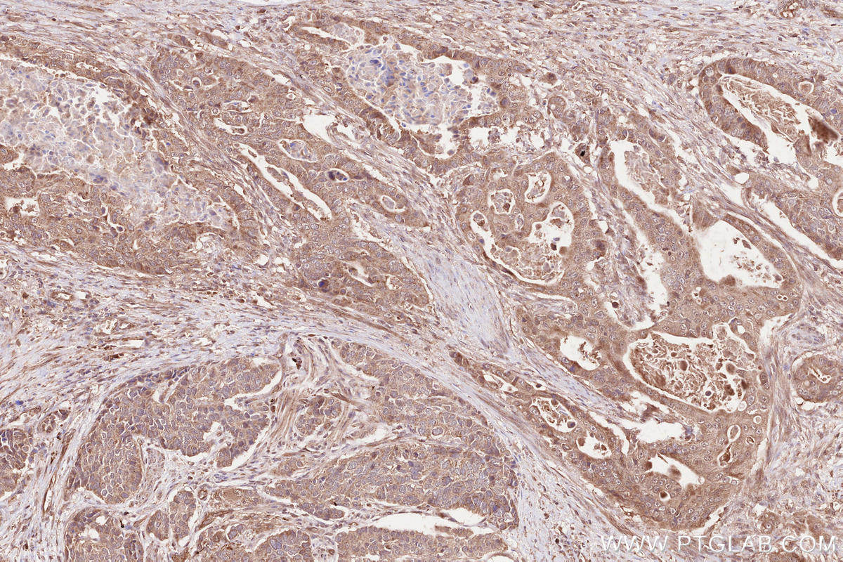 Immunohistochemical analysis of paraffin-embedded human stomach cancer tissue slide using KHC2530 (CRY2 IHC Kit).