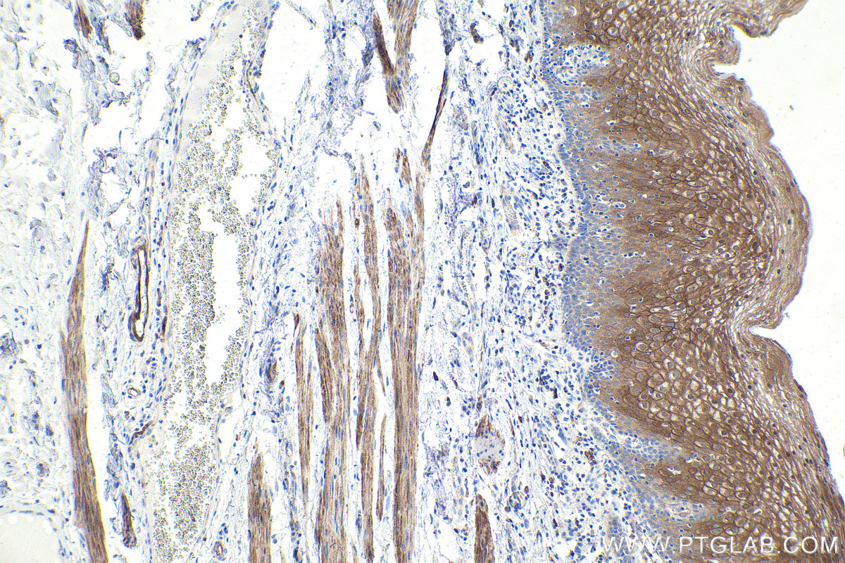 Immunohistochemical analysis of paraffin-embedded human oesophagus cancer tissue slide using KHC1964 (CTNNBIP1 IHC Kit).