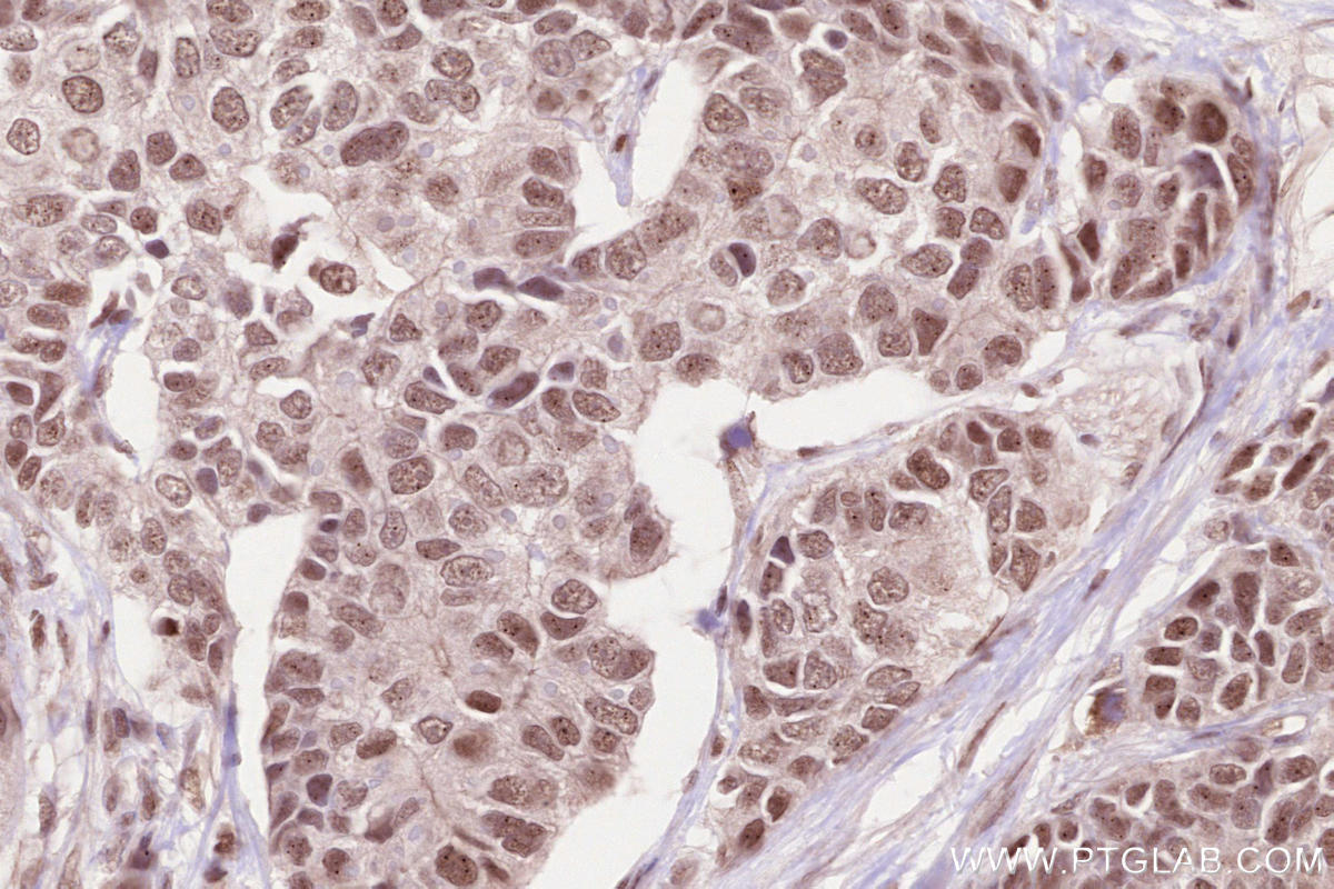 Immunohistochemical analysis of paraffin-embedded human stomach cancer tissue slide using KHC2587 (CTR9 IHC Kit).