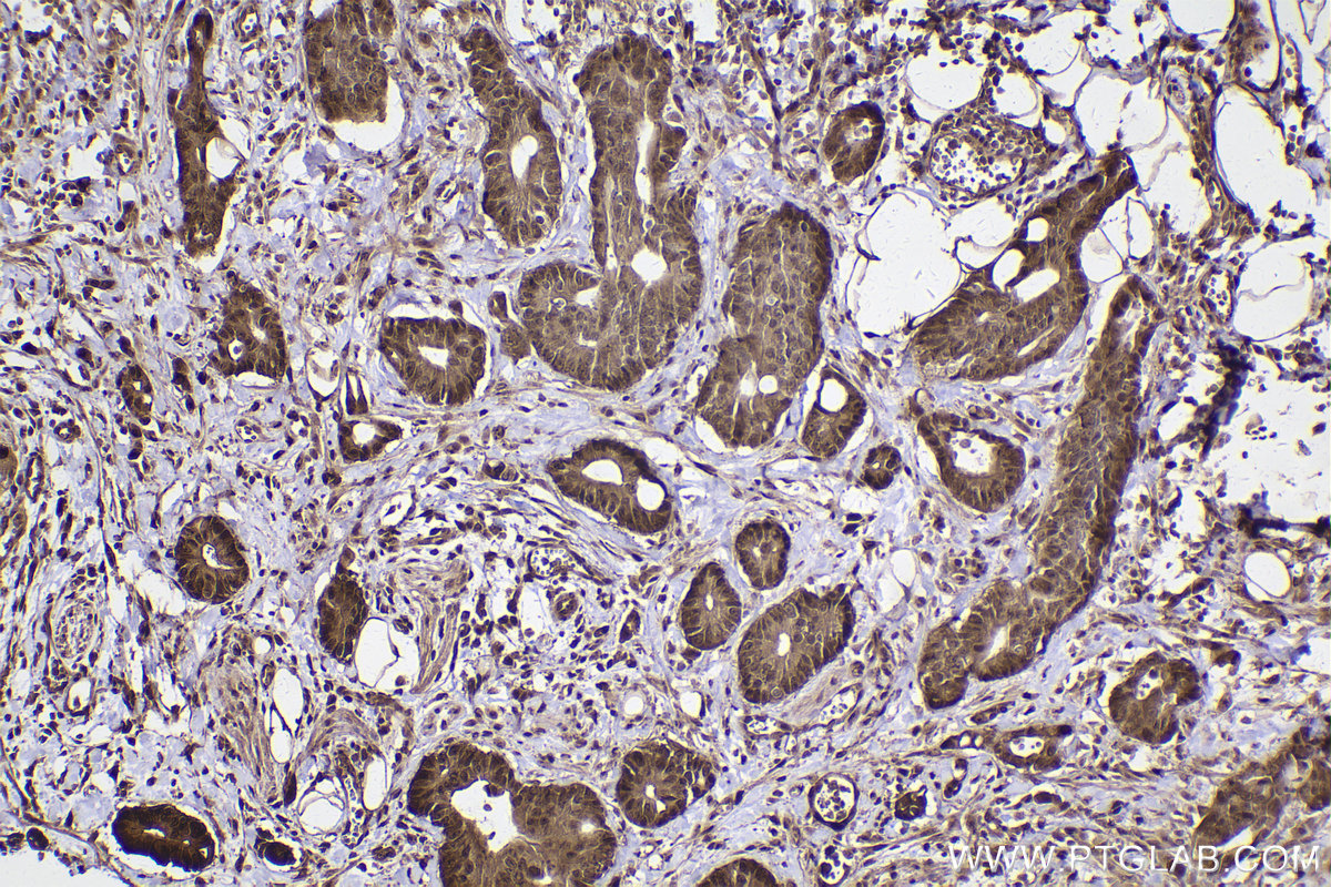 Immunohistochemical analysis of paraffin-embedded human rectal cancer tissue slide using KHC2438 (CUL4A IHC Kit).