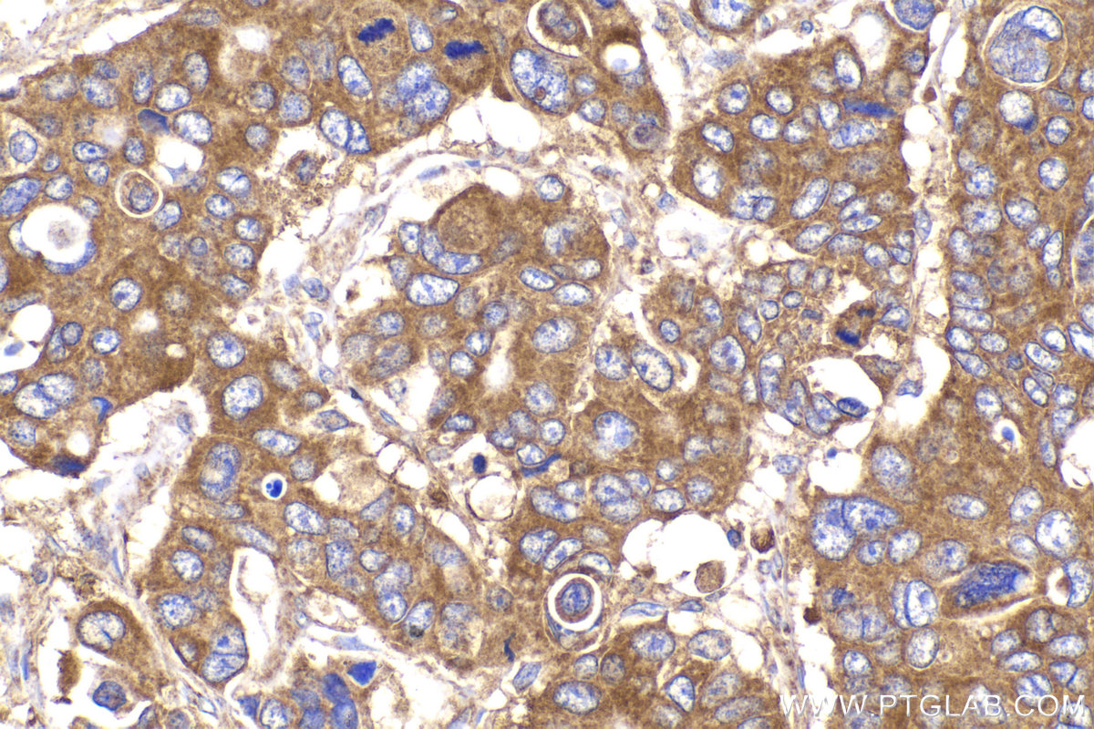 Immunohistochemical analysis of paraffin-embedded human stomach cancer tissue slide using KHC2157 (CYP1A1 IHC Kit).