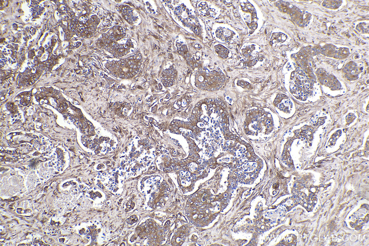 Immunohistochemical analysis of paraffin-embedded human stomach cancer tissue slide using KHC2187 (CALM3 IHC Kit).