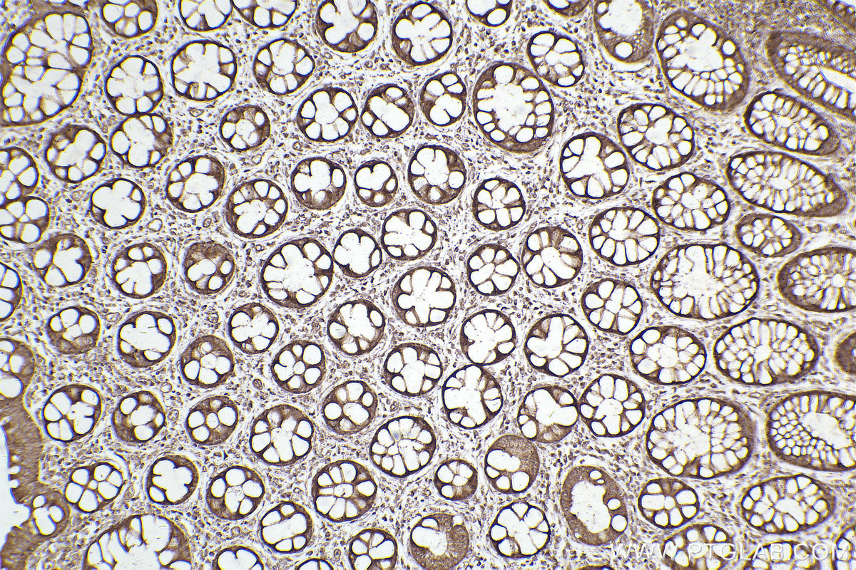 Immunohistochemical analysis of paraffin-embedded human rectal cancer tissue slide using KHC2503 (Cryptochrome 1/CRY1 IHC Kit).